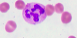 Megaloblastic Anemia