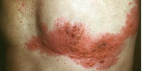 Macroscopic Skin Lesions